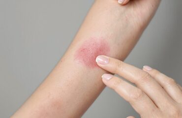 comment reconnaître un eczéma de contact