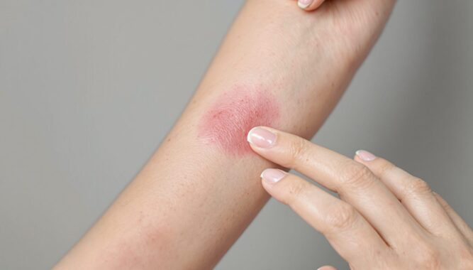 comment reconnaître un eczéma de contact